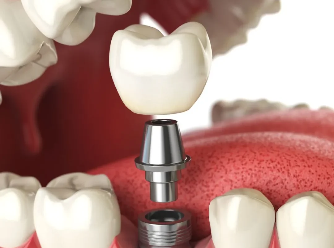 dental implants in barbados