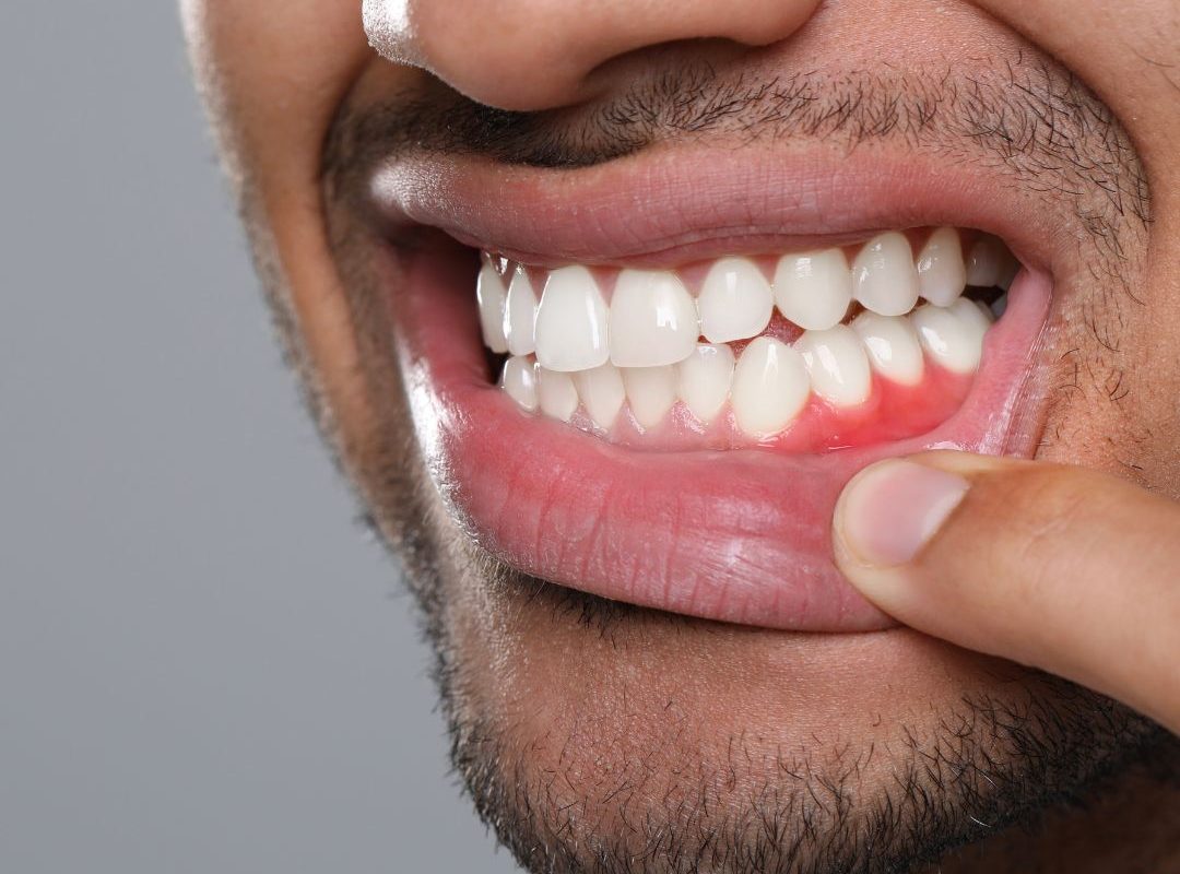 gum disease in barbados