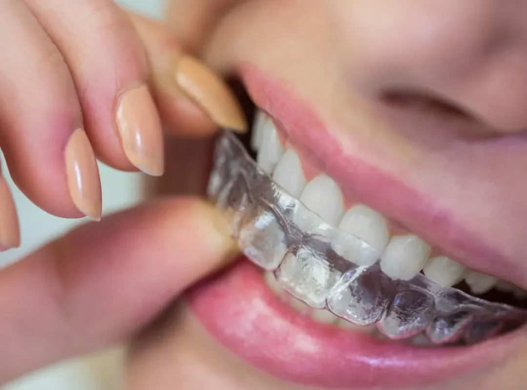 invisalign in barbados