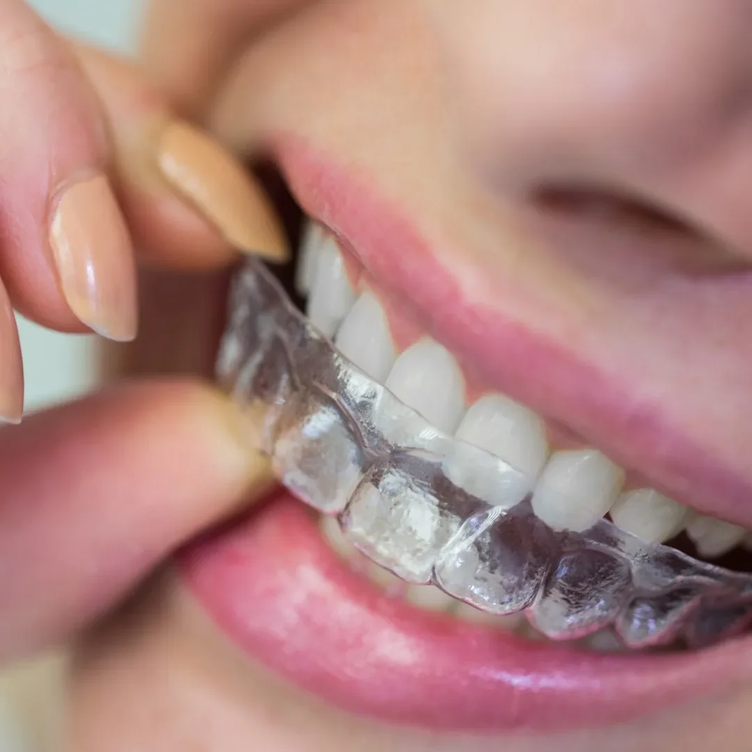 invisalign retainers barbados