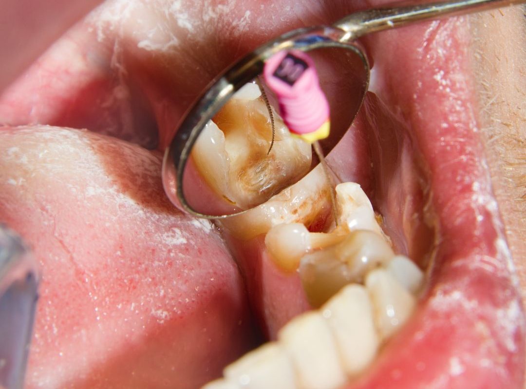 root canal therapy in barbados
