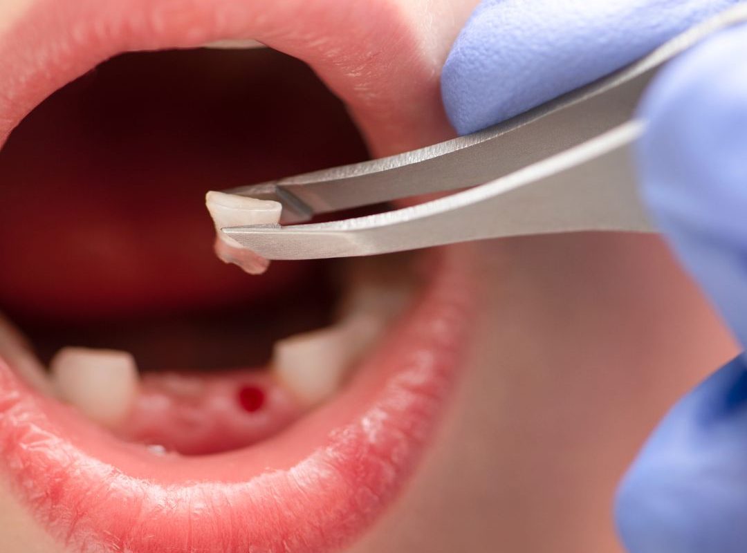 tooth extractions in barbados