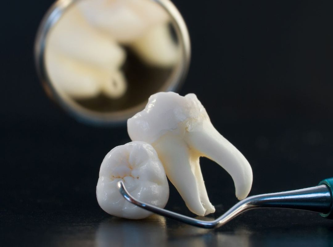 wisdom tooth removal in barbados